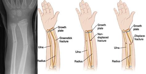 Greenstick fractures - Symptoms and causes treated? In most cases ...