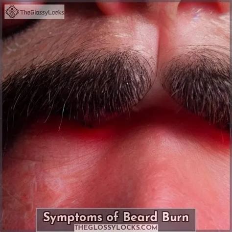 What Causes Beard Burn? Friction, Androgens, & More - Learn Here!