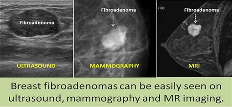 NONSURGICAL TREATMENT OF BREAST FIBROADENOMAS