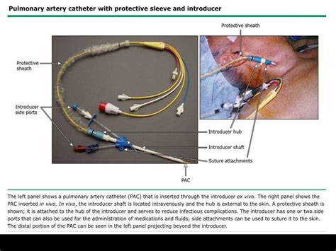 Pulmonary artery catheter