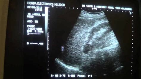 ultrasound of liver cirrhosis - YouTube