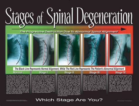 What is an Atlas Misalignment? – Reconnection Chiropractic