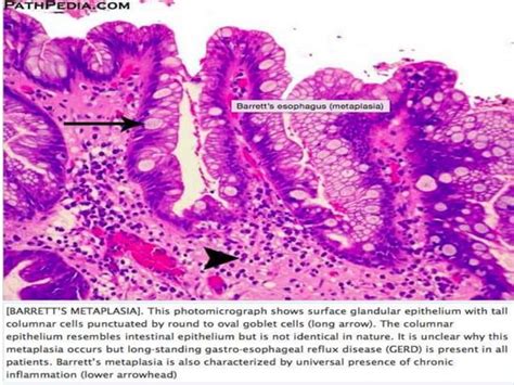 Barrett's Oesophagus for the Histopathologist.