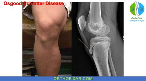 Osgood Schlatter Disease - Full Detailed | OrthoFixar 2024