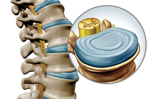 Sunset Chiropractic & Wellness Research Review: Biomechanical effect of C5-C6 intervertebral ...