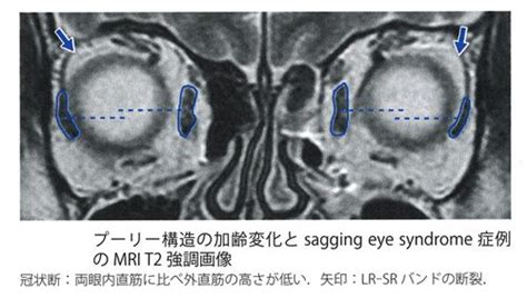 Sagging eye syndrome（加齢性斜視） | 医療法人 中村眼科