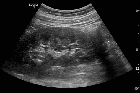 Normal Kidney Ultrasound