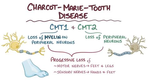 Charcot-Marie-Tooth disease: Video & Anatomy | Osmosis