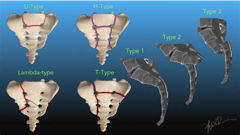 Classification of Transverse Sacral Fractures | UW Emergency Radiology