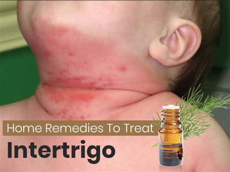 How To Treat Intertrigo: Safe And Effective Home Remedies - Boldsky.com