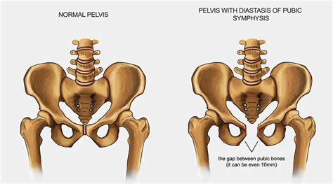 3 Ways to Decrease Pubic Symphysis Pain During Pregnancy — Heppe ...