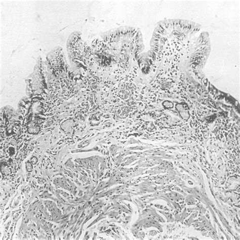 Gastric biopsy specimen of the antrum showing severe atrophy. Only a ...