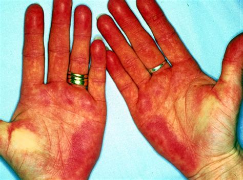 Palmar Erythema - Pictures, Definition, Causes, Treatment