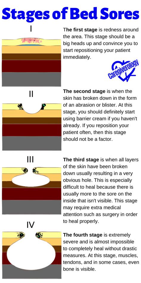 Bed Sores Explained in Detail - Caregiverology | Home health nurse, Bed sores, Wound care nursing