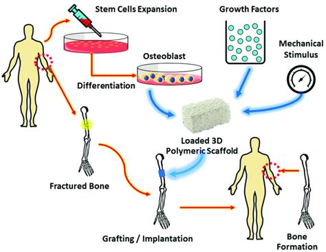 Bone tissue scaffold implantation. | Download Scientific Diagram