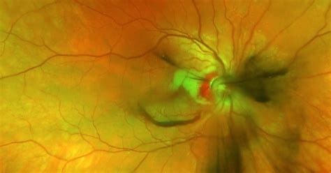 Partial Optic Disc Avulsion with Optic Disc Pit - Retina Image Bank