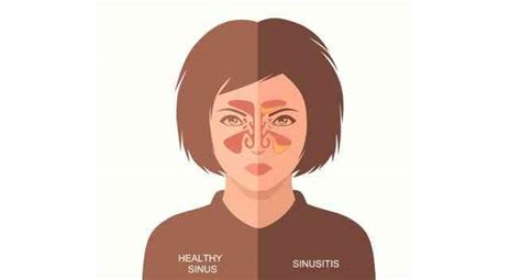 10 Natural Remedies for Sinus Infection | RunnerGuru