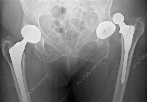 Dislocated hip replacement, X-ray - Stock Image - C010/3496 - Science Photo Library