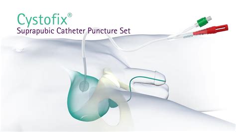 Suprapubic Catheter Set