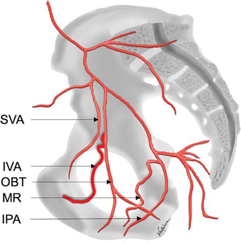 Obturator Artery Angiogram