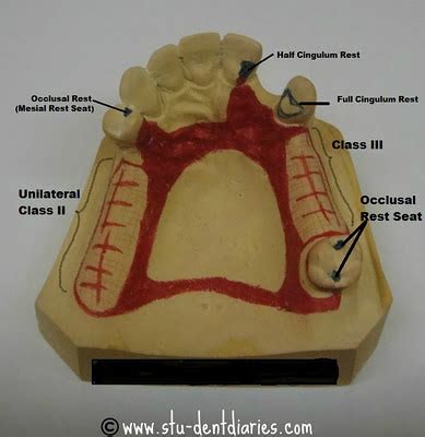 Stu-DENT Diaries: Fabrication of Removable Partial Dentures