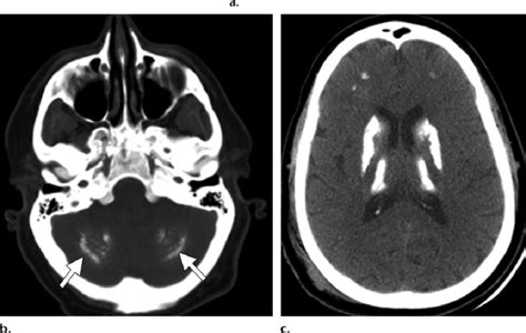 Hyperparathyroidisn in two patients. (a) Axial unenhanced CT image... | Download Scientific Diagram