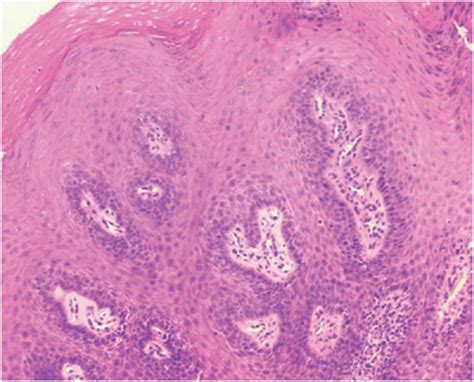 Medical Terms & Сlinical Сases : Oral Wart (Squamous Papilloma)