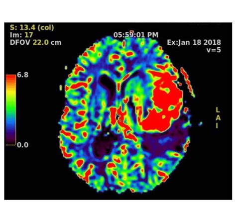 Magnetic Resonance Perfusion. Brain perfusion MR sequence demonstrating ...