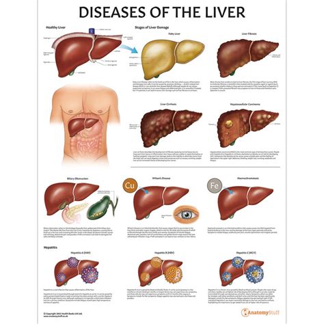 Diseases of the Liver Chart/Poster Laminated