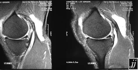 Popliteal cyst – Radiopaedia