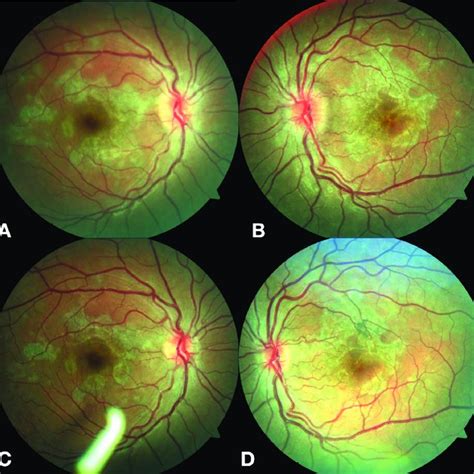 (PDF) Treatment Outcomes Of Patients With Serpiginous And Serpiginous-Like Choroiditis