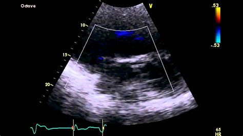 Ebstein's Anomaly - Transthoracic Echocardiogram (TTE) | Echocardiogram ...