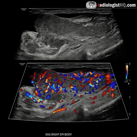 Epididymitis Ultrasound