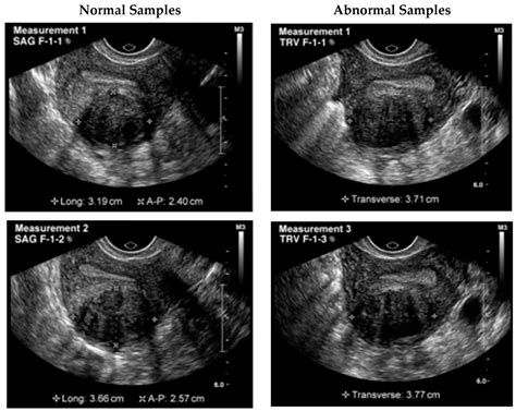 Uterine Fibroids Ultrasound