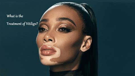 What is the Treatment of Vitiligo? – Learning Joan