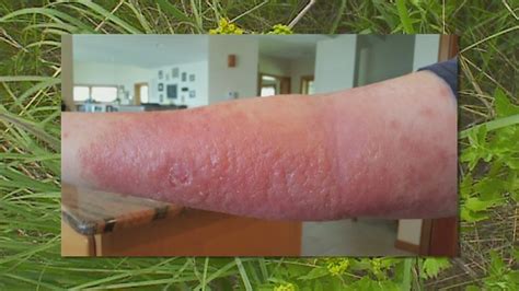 Gardener Has Painful Encounter With Wild Parsnip - YouTube