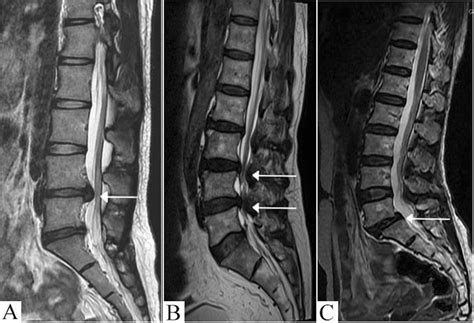 Classification of patients into subgroups by MRI imaging. (A) Subgroup ...