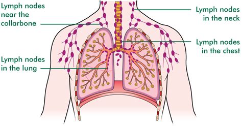 Lung Cancer Swollen Lymph Nodes