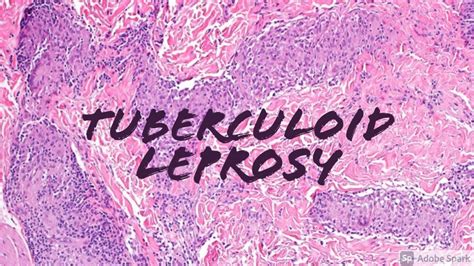 Tuberculoid Leprosy (Hansen disease): 5-Minute Pathology Pearls Dermatology Dermatopathology ...