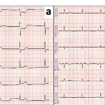 Electrocardiogram (ECG) after administration of paclitaxel. a ECG ...