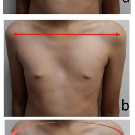 (a) Depth of the pectus deformity at the most collapsed area in the ...