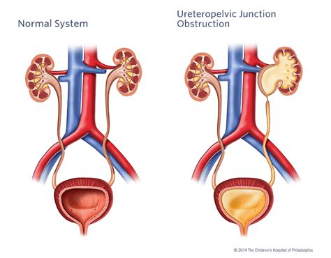 da Vinci Pyeloplasty | Urinary Treatment | Austin Urology Institute