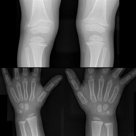 Hereditary Hypophosphatemic Rickets | Pediatric Radiology Reference ...