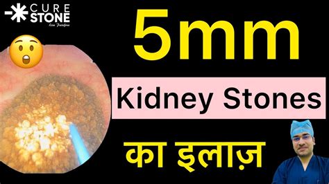 5mm Kidney Stone का इलाज? | Treatment for 5 mm Kidney stones in Hindi | RIRS for 5mm Stone #rirs ...