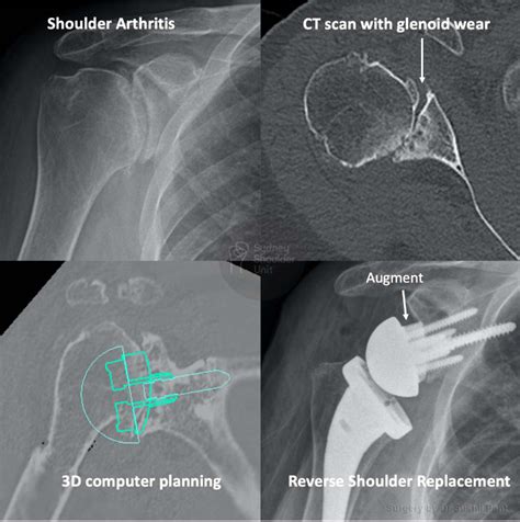 Reverse Shoulder Replacement | Medical Case Study | Sydney Shoulder Unit