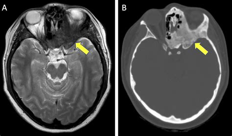 Skull base imaging, anatomy, pathology and protocols | Practical Neurology