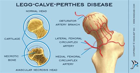 What is Legg-Calvé-Perthes’ Disease? - MASS4D® Foot Orthotics