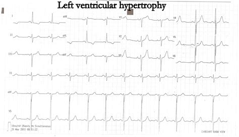 How to miss left ventricular hypertrophy in ECG ? | Dr.S.Venkatesan MD