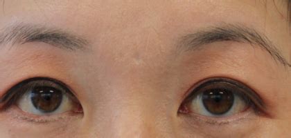 Patient #14543 Bunny Lines Before and After Photos Santa Monica - Plastic Surgery Gallery Los ...