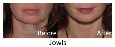 Help for sagging cheeks/jowls | BabyCenter